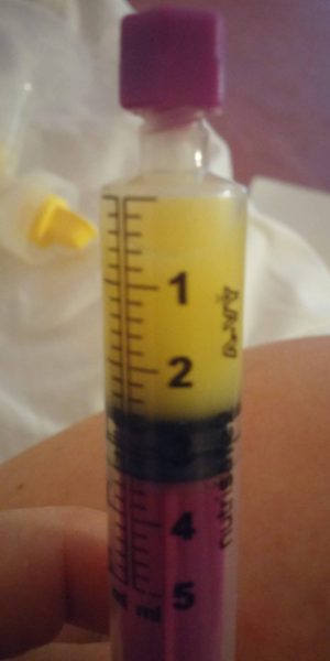 Siara w strzykawce dla wcześniaka